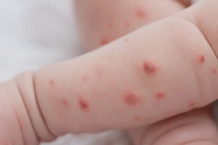 新生兒四肢偶爾起濕疹不管它會(huì)自己痊愈嗎(圖4)
