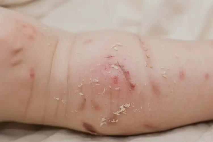 少兒小腿上容易起濕疹不管它會自己好嗎(圖3)