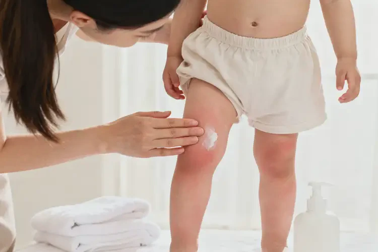 小兒大腿上有濕疹能夠徹底治愈嗎(圖2)