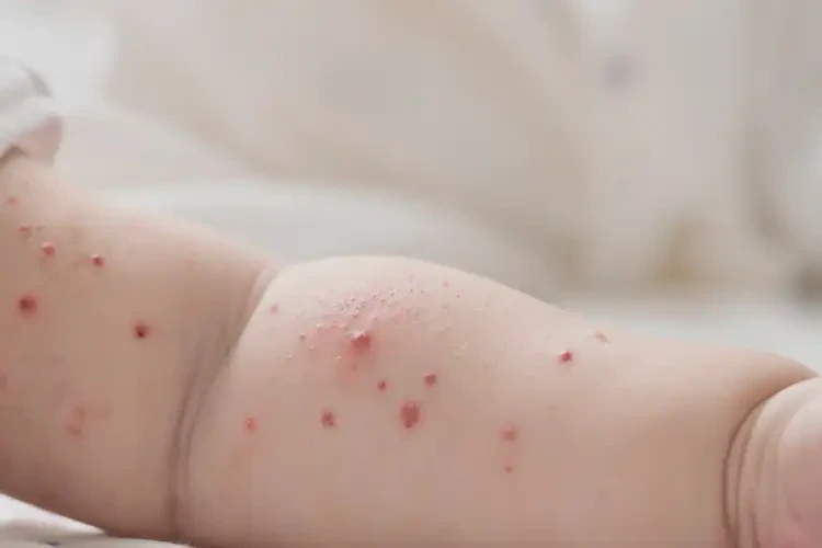 小儿手臂经常起湿疹能靠自己自愈吗(图4)