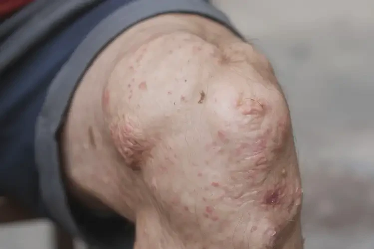 高齡老人大腿上經(jīng)常長(zhǎng)濕疹能徹底自愈嗎(圖4)