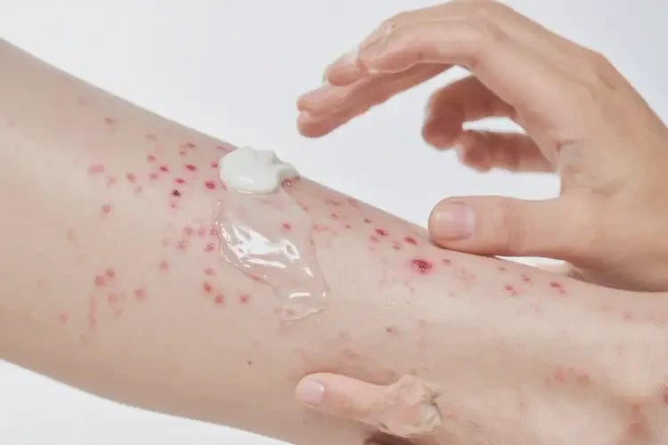 青年人小腿上有濕疹不管它會自己好嗎(圖2)