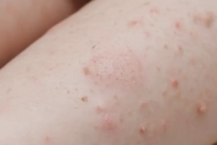 小孩四肢偶爾起濕疹不管它會(huì)自己好嗎(圖4)