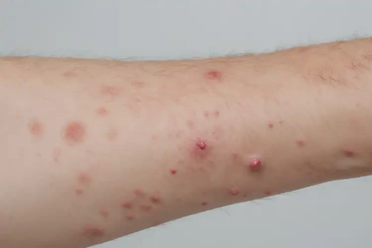 中学生手臂上偶尔起湿疹不管它会自己痊愈吗(图4)