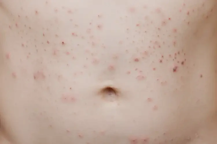 小學生肚子上容易起濕疹能不能徹底自愈(圖4)