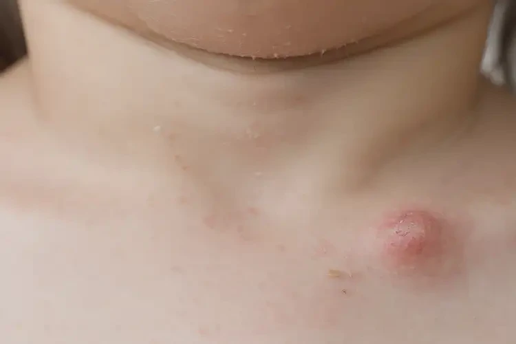 兒童脖子上出濕疹能靠自己自愈嗎(圖4)