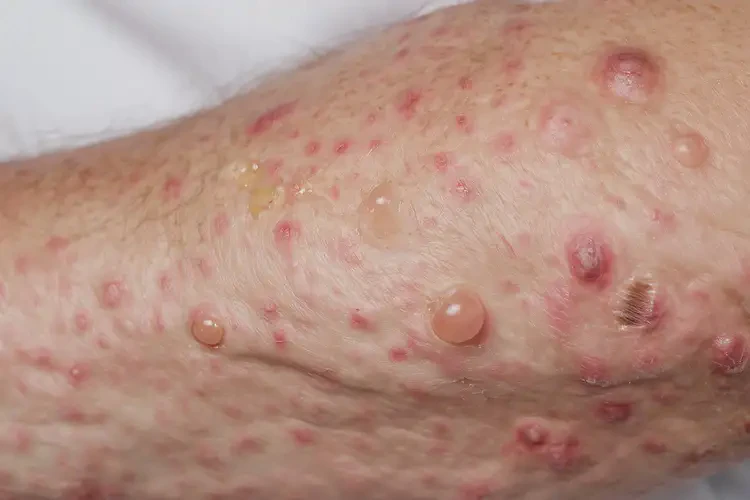 大學生小腿容易長濕疹不管它會自己痊愈嗎(圖3)