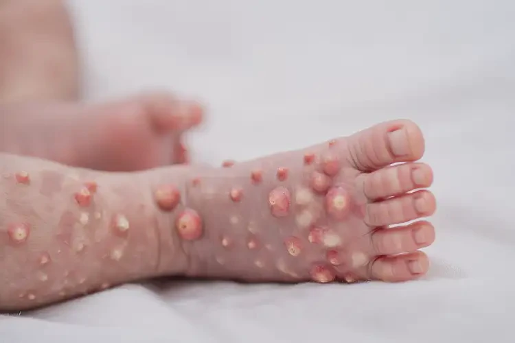 新生兒小腿出現(xiàn)濕疹不管它會(huì)自己自愈嗎(圖2)