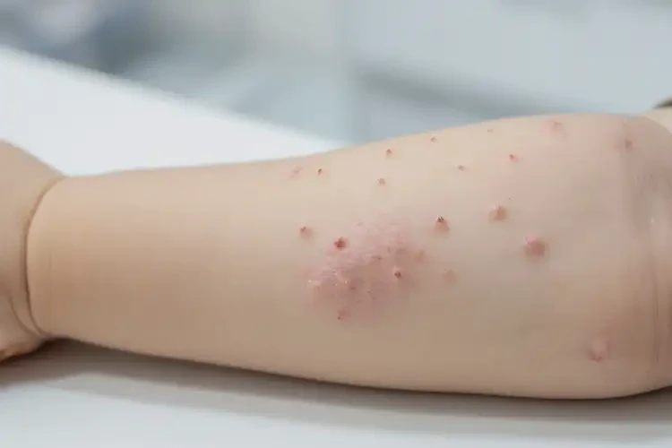 小孩手臂经常长湿疹可不可以彻底自愈(图4)