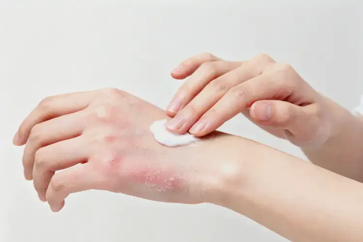 女性手上有濕疹不管它會(huì)自己自愈嗎(圖2)