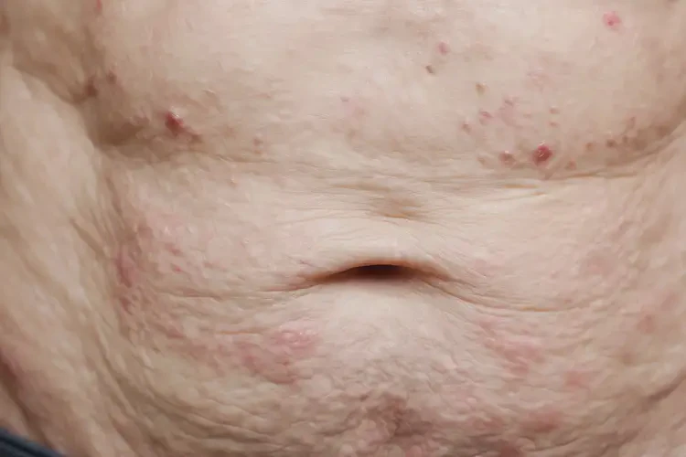 高龄老人肚子偶尔起湿疹不管它会自己好吗(图4)