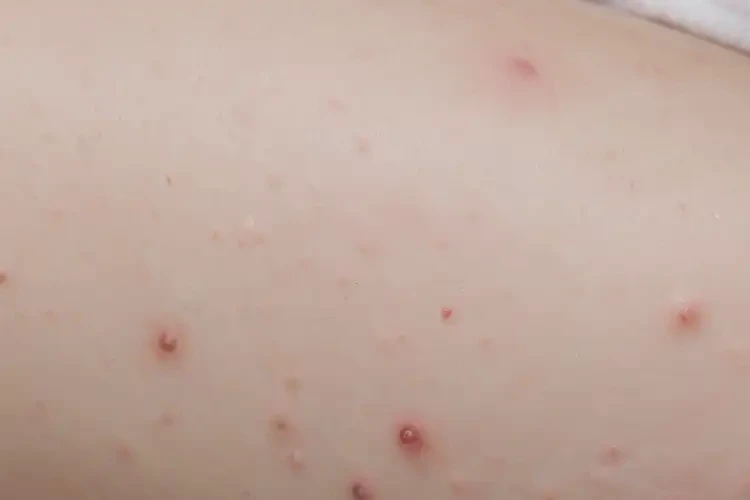 嬰幼兒身上出現(xiàn)濕疹能靠自己自愈嗎(圖4)