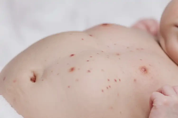 新生兒肚子經(jīng)常長(zhǎng)濕疹不管它會(huì)自己自愈嗎(圖4)