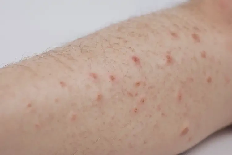 大學生小腿容易長濕疹不管它會自己痊愈嗎(圖4)