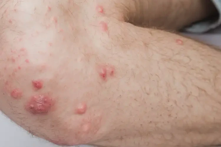 男性小腿上经常长湿疹能靠自己自愈吗(图4)