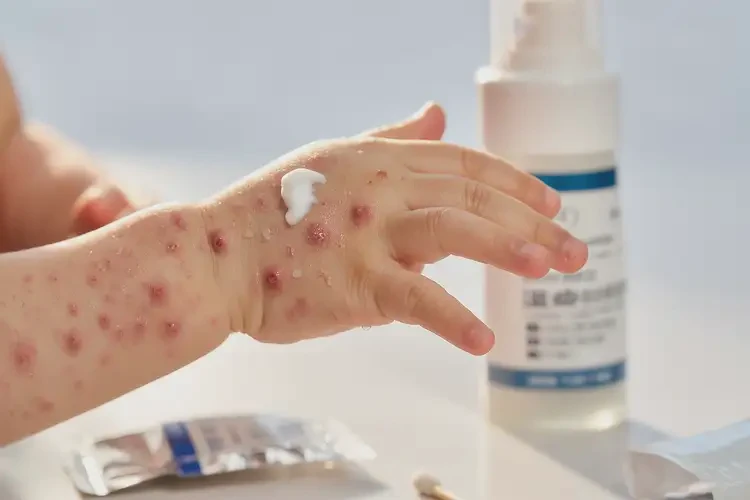 小儿手上经常起湿疹能够彻底治愈吗(图3)