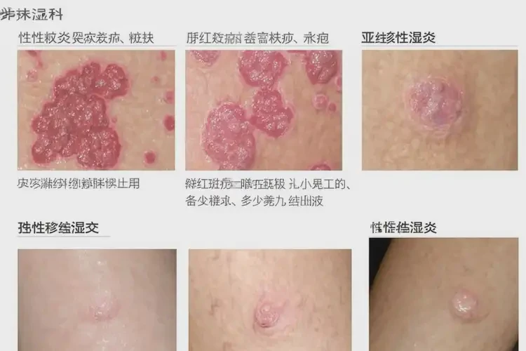 男人身上經(jīng)常長濕疹不管它會(huì)自己好嗎(圖3)