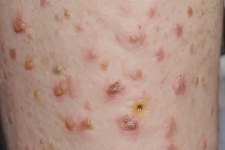 少儿身上偶尔长湿疹不管它会自己痊愈吗(图3)