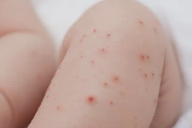 新生兒小腿出現(xiàn)濕疹不管它會(huì)自己自愈嗎(圖4)