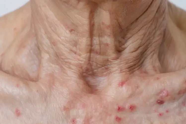 老年人脖子上经常起湿疹可以彻底自愈吗(图4)