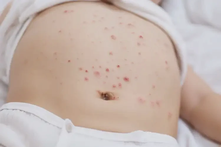 幼兒肚子長濕疹能靠自己自愈嗎(圖4)