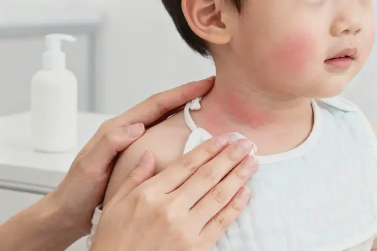 孩子脖子长湿疹可以彻底自愈吗(图2)