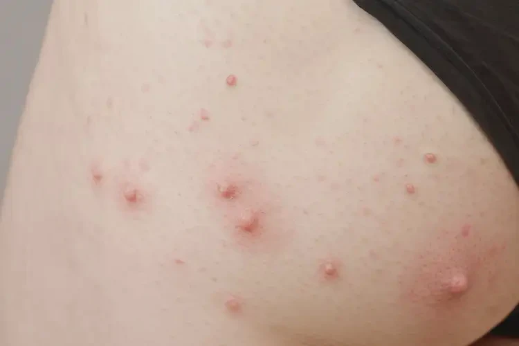 女性屁股經(jīng)常起濕疹能夠徹底治愈嗎(圖4)