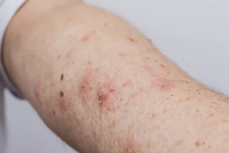 中學(xué)生手臂上容易長(zhǎng)濕疹能不能徹底自愈(圖4)