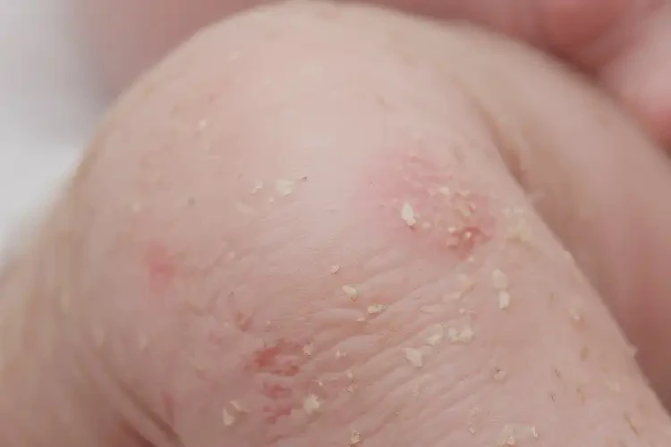 新生兒小腿偶爾起濕疹可不可以徹底自愈(圖4)