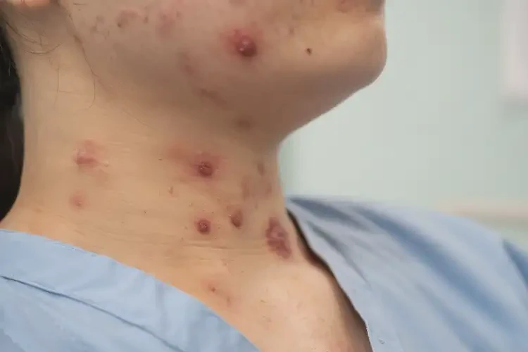 產婦脖子上起濕疹可以徹底自愈嗎(圖4)