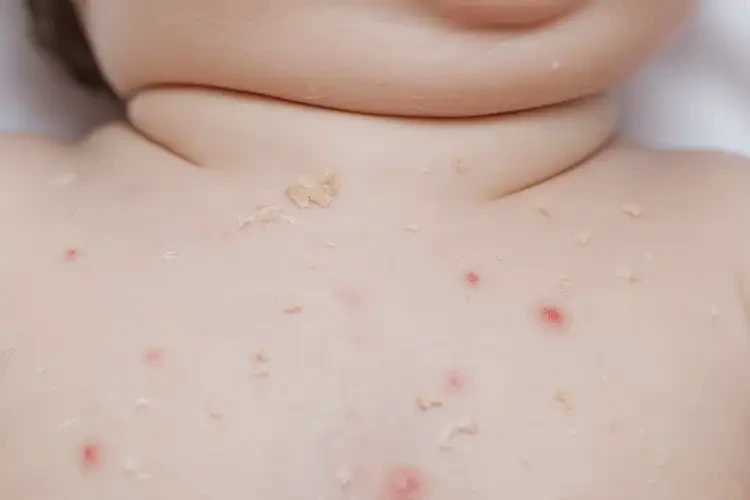 宝宝脖子起湿疹不管它会自己痊愈吗(图3)