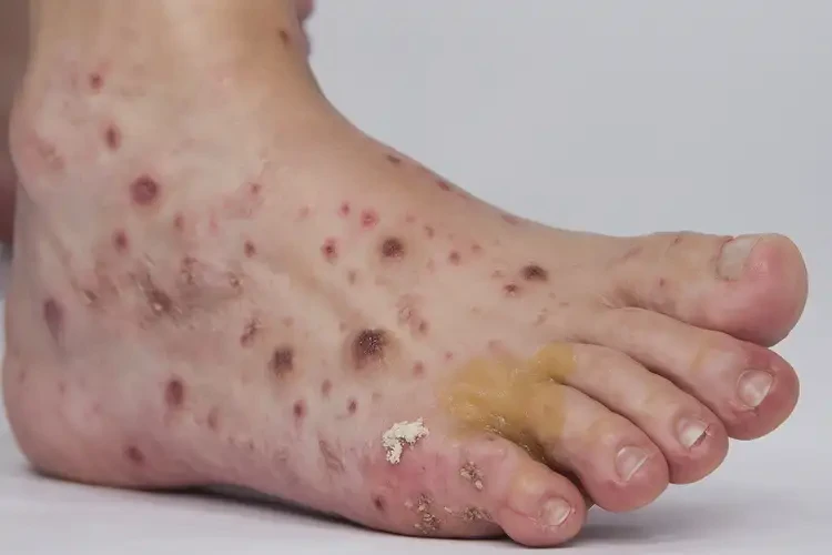 青少年腳上經(jīng)常起濕疹能不能徹底自愈(圖4)