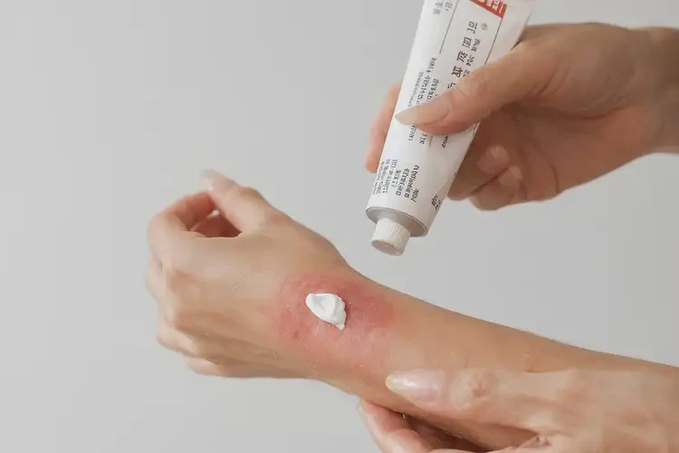 兒童大腿上經(jīng)常長濕疹能靠自己自愈嗎(圖2)