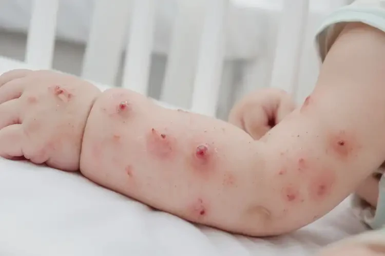 嬰兒全身容易起濕疹可不可以徹底自愈(圖4)