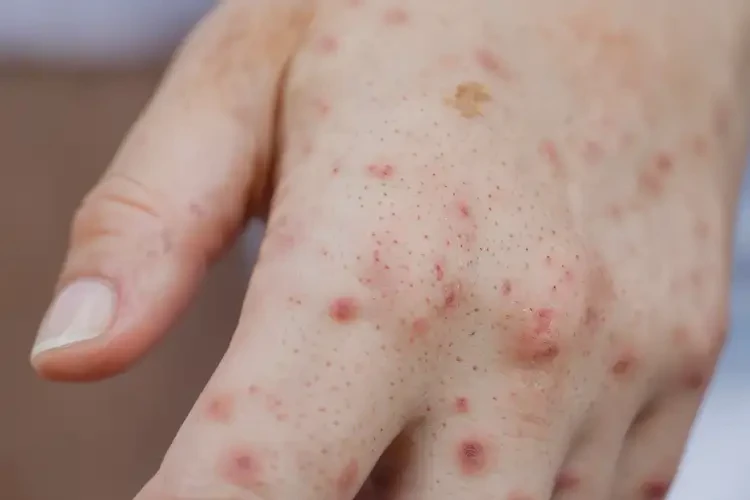 中學(xué)生手上有濕疹不管它會(huì)自己自愈嗎(圖4)