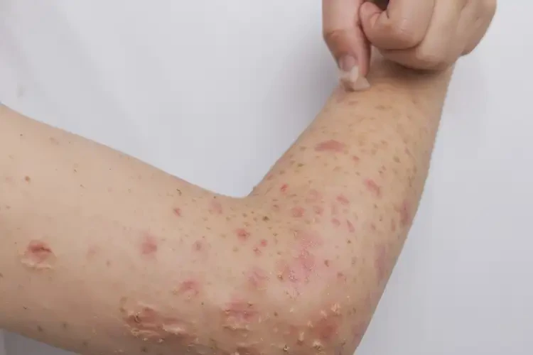 青少年手上出濕疹能靠自己自愈嗎(圖4)