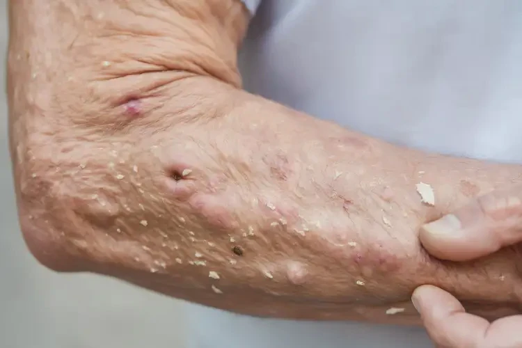 老年人手臂上出湿疹不管它会自己好吗(图4)