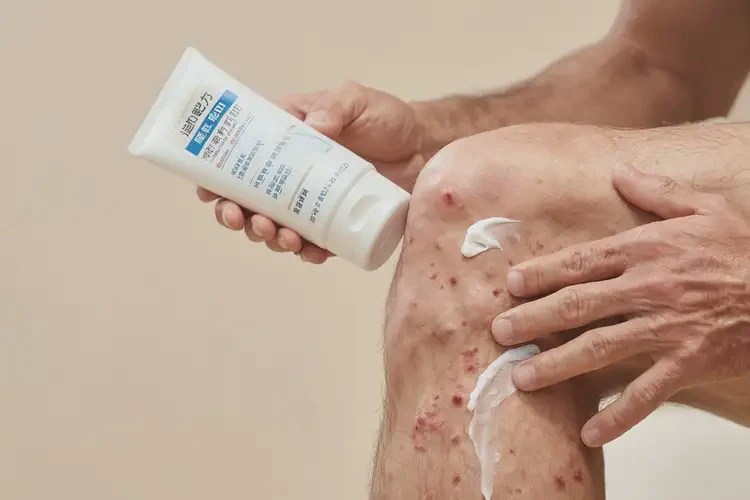 男性大腿偶尔长湿疹能靠自己自愈吗(图3)