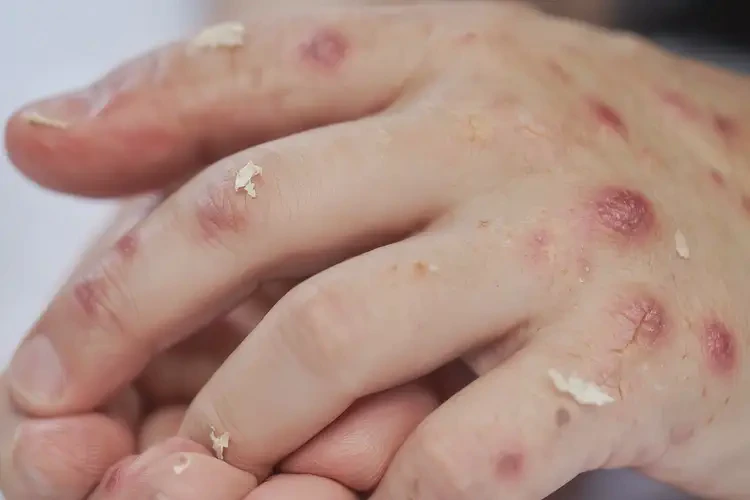 青少年手上偶爾長濕疹能徹底自愈嗎(圖4)