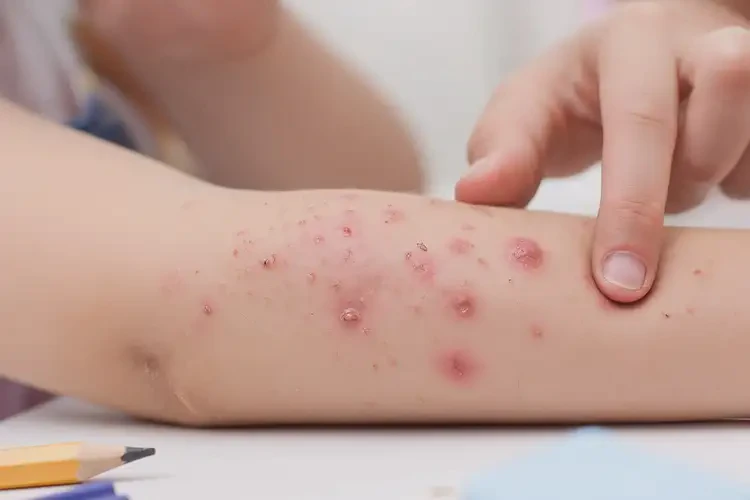 小学生手臂长湿疹能彻底自愈吗(图4)