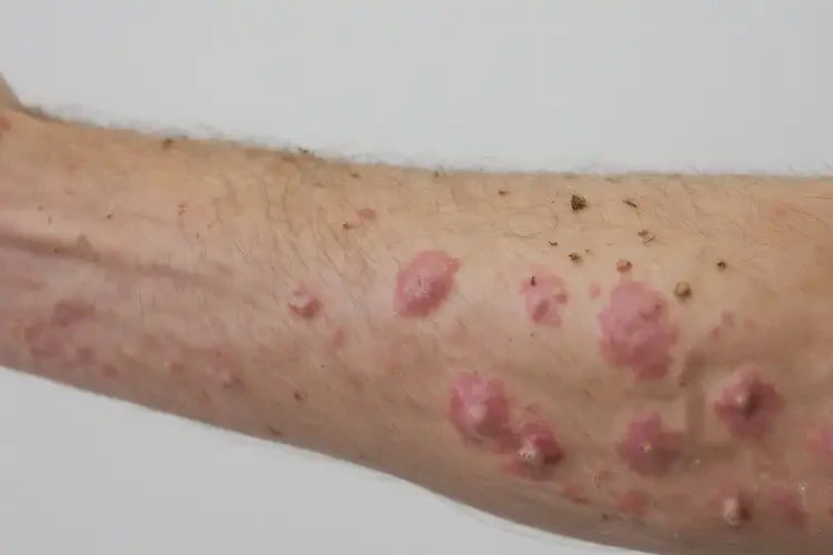 男人身上有濕疹不管它會自己好嗎(圖4)