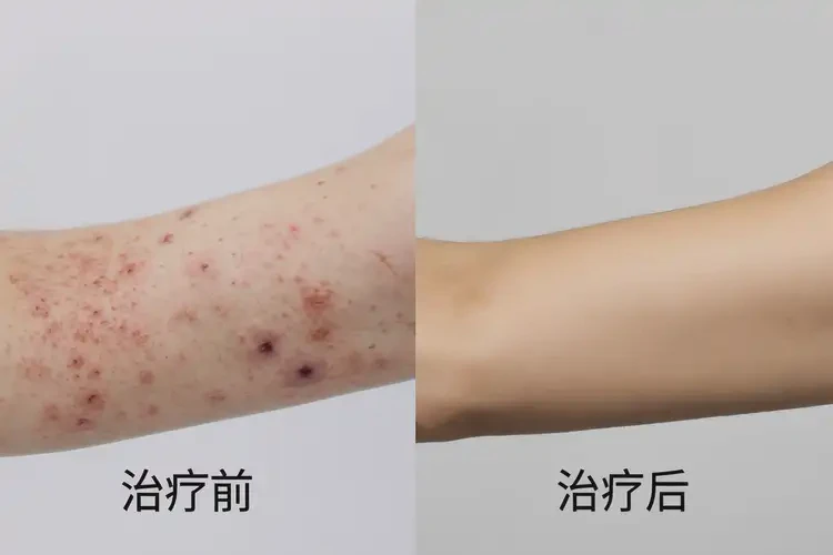 中學(xué)生手臂上容易長(zhǎng)濕疹能不能徹底自愈(圖1)
