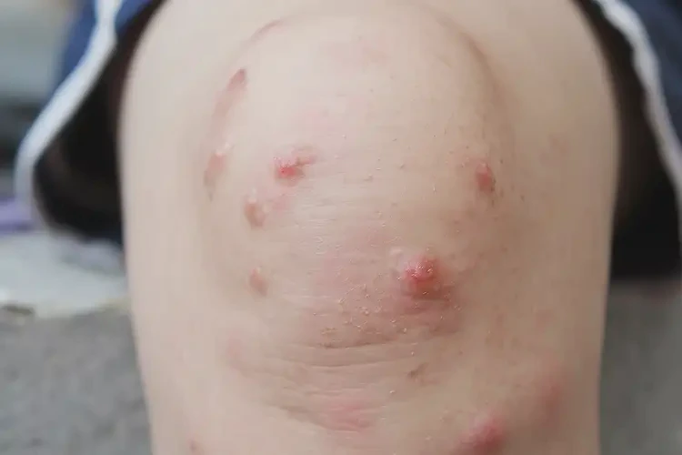 小学生小腿上经常起湿疹不管它会自己痊愈吗(图4)