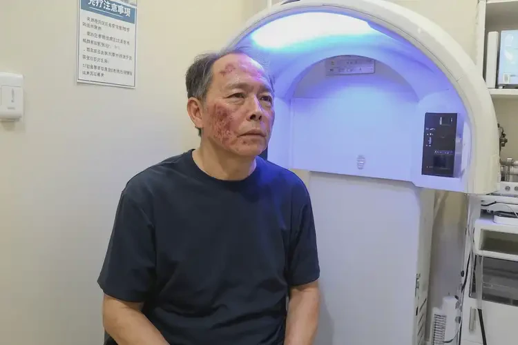 男人脸上长湿疹可不可以彻底自愈(图1)