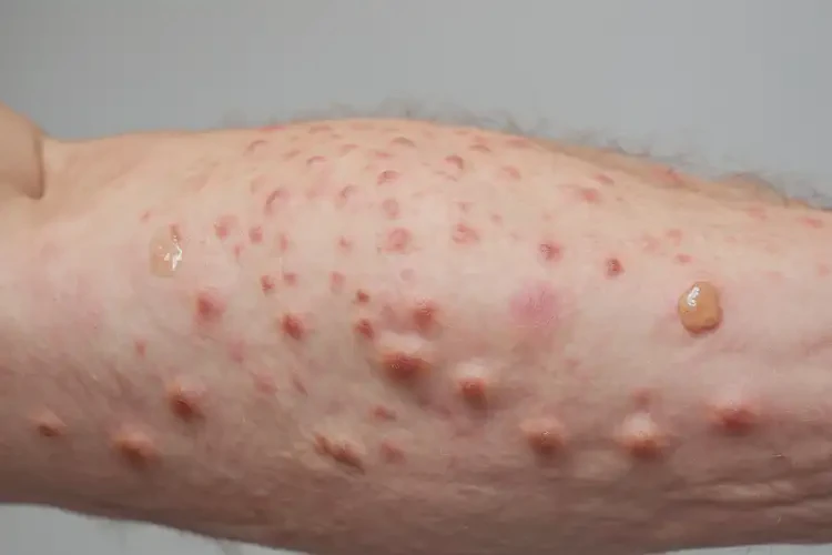 小兒四肢偶爾長濕疹不管它會自己好嗎(圖3)