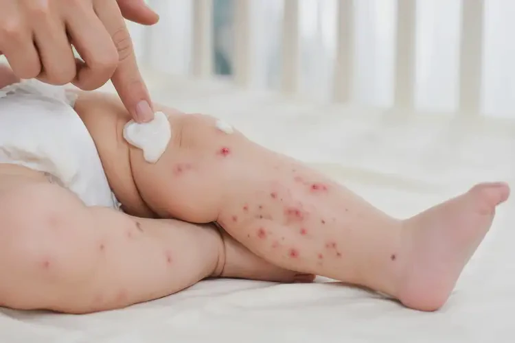 嬰兒小腿容易長濕疹能徹底自愈嗎(圖3)