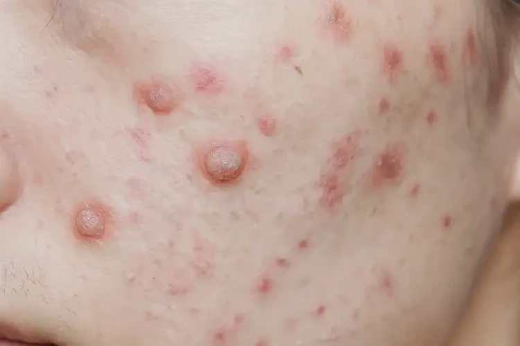 老年人大腿上偶爾長(zhǎng)濕疹不管它會(huì)自己痊愈嗎(圖3)