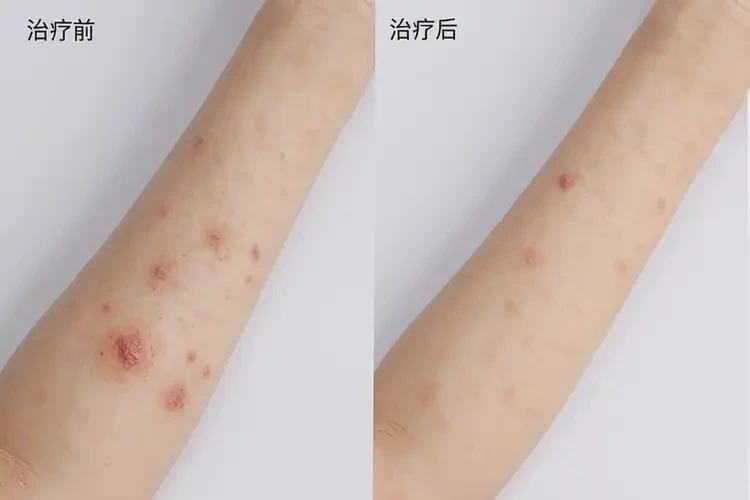 女性手臂上容易起濕疹不管它會自己自愈嗎(圖1)