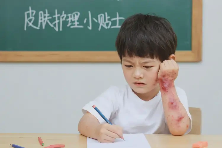 小学生手上容易长湿疹不管它会自己自愈吗(图4)
