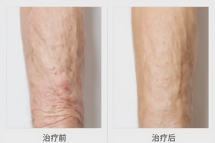 高龄老人脸上偶尔长湿疹不管它会自己好吗(图2)